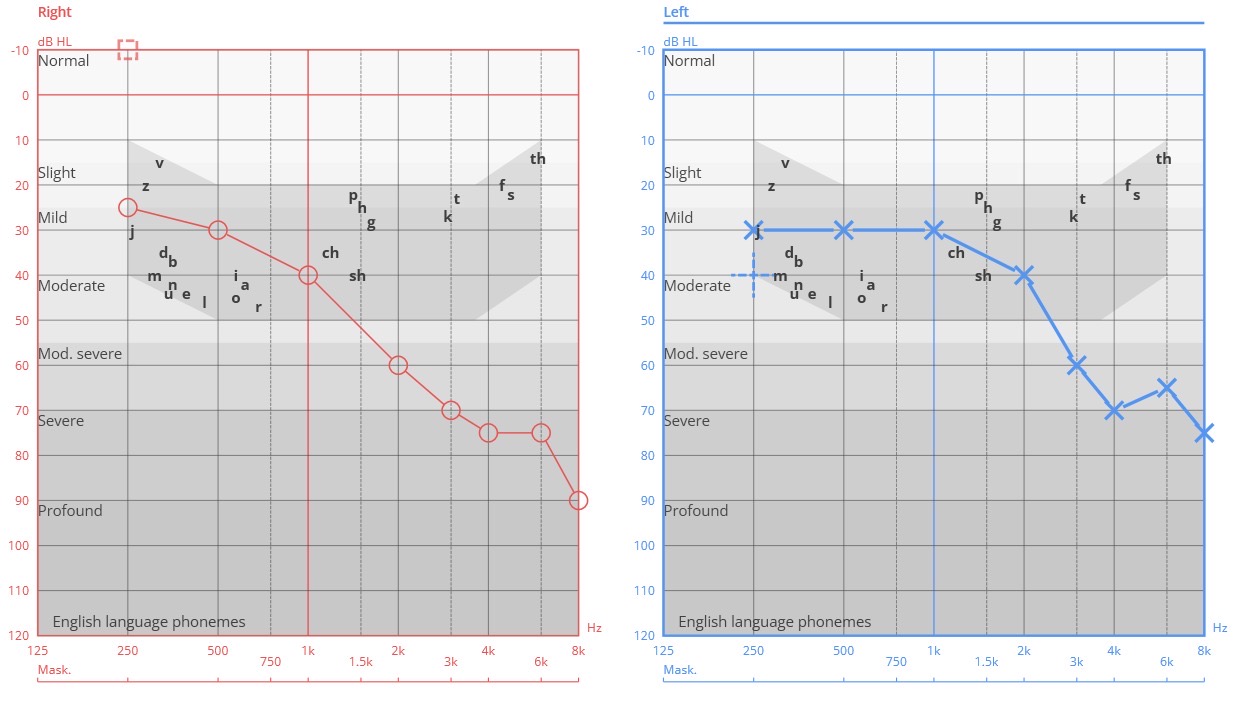 Example audiogram for the right and left ear, with the speech banana shaded and English speech sounds marked. Hearing is mild at low pitches and drops steeply at higher pitches in both ears, so soft high-pitched sounds such as k, t, f, s and th are missed.